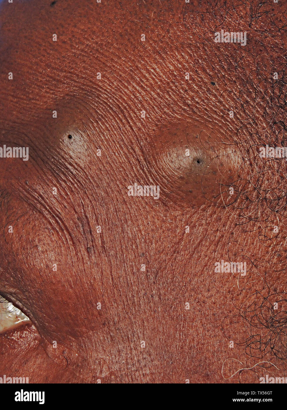 Kyste Sébacé Radiopaedia: Kyste Sébacé Traitements – SDYEM