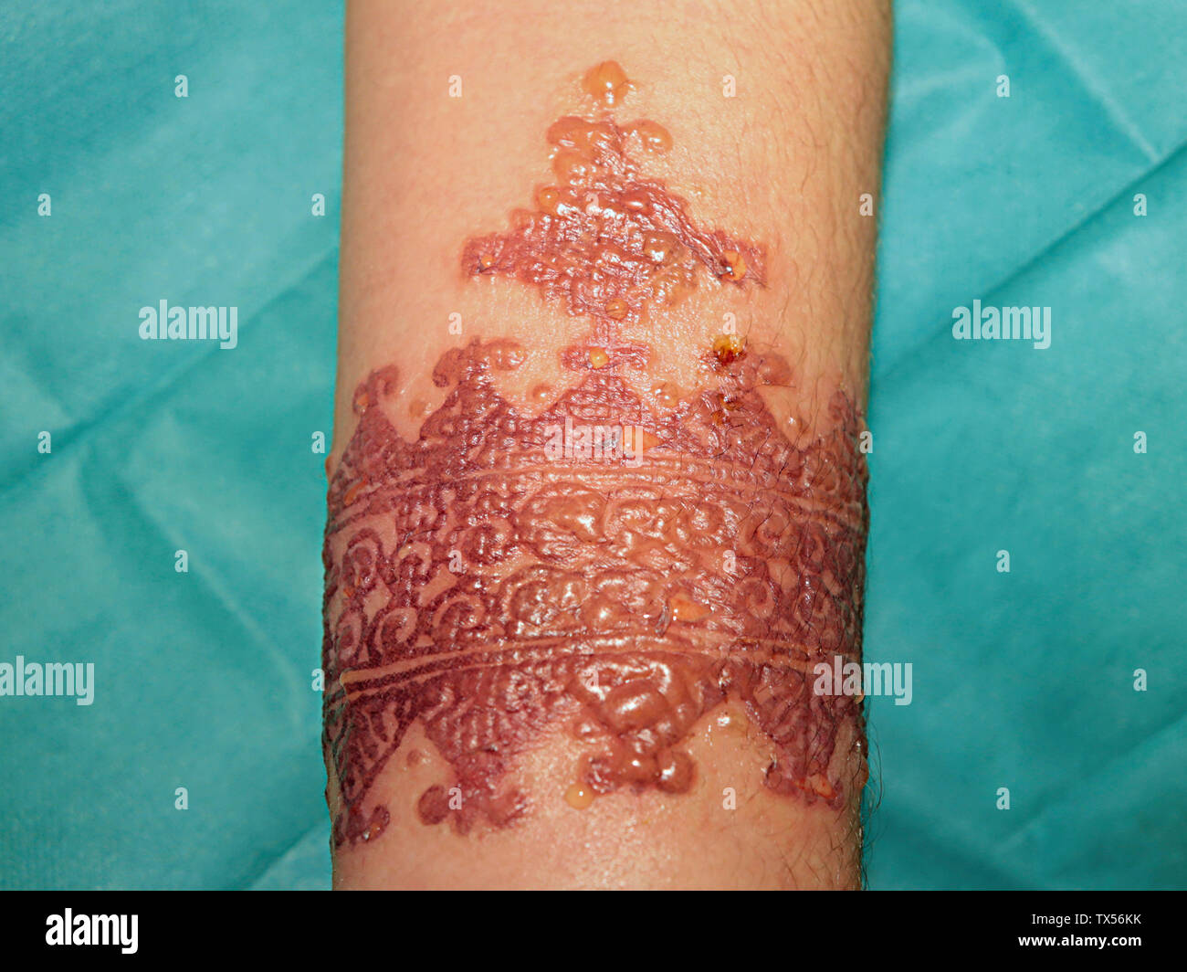Réaction allergique importante après un tatouage au henné Banque D'Images