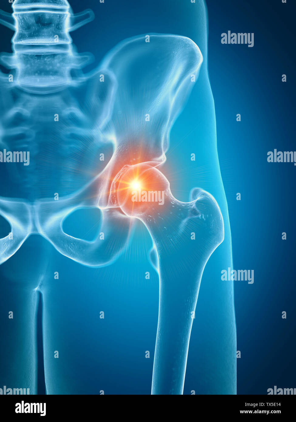 Rendu 3D précis médicalement illustration d'une hanche douloureuse Banque D'Images