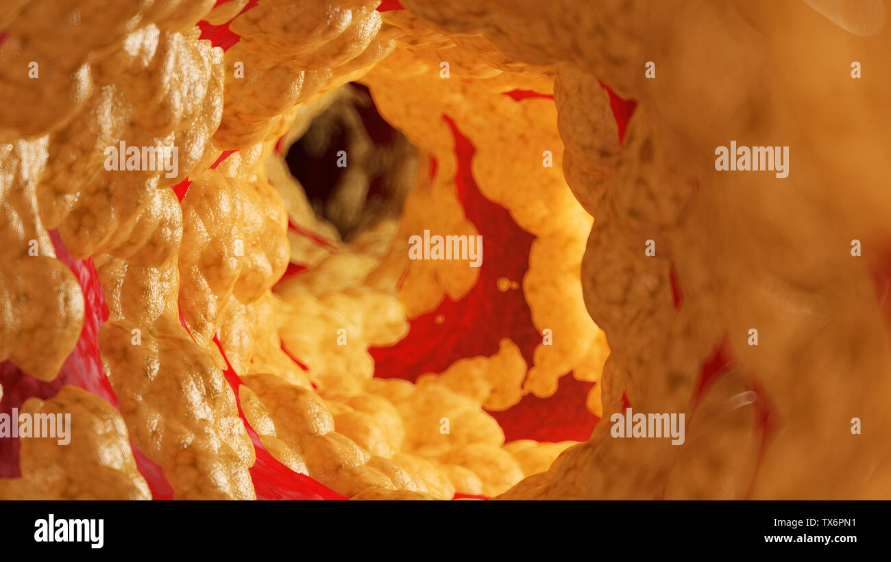 Médicalement en rendu 3d illustration précise de la graisse à l'intérieur d'une artère Banque D'Images