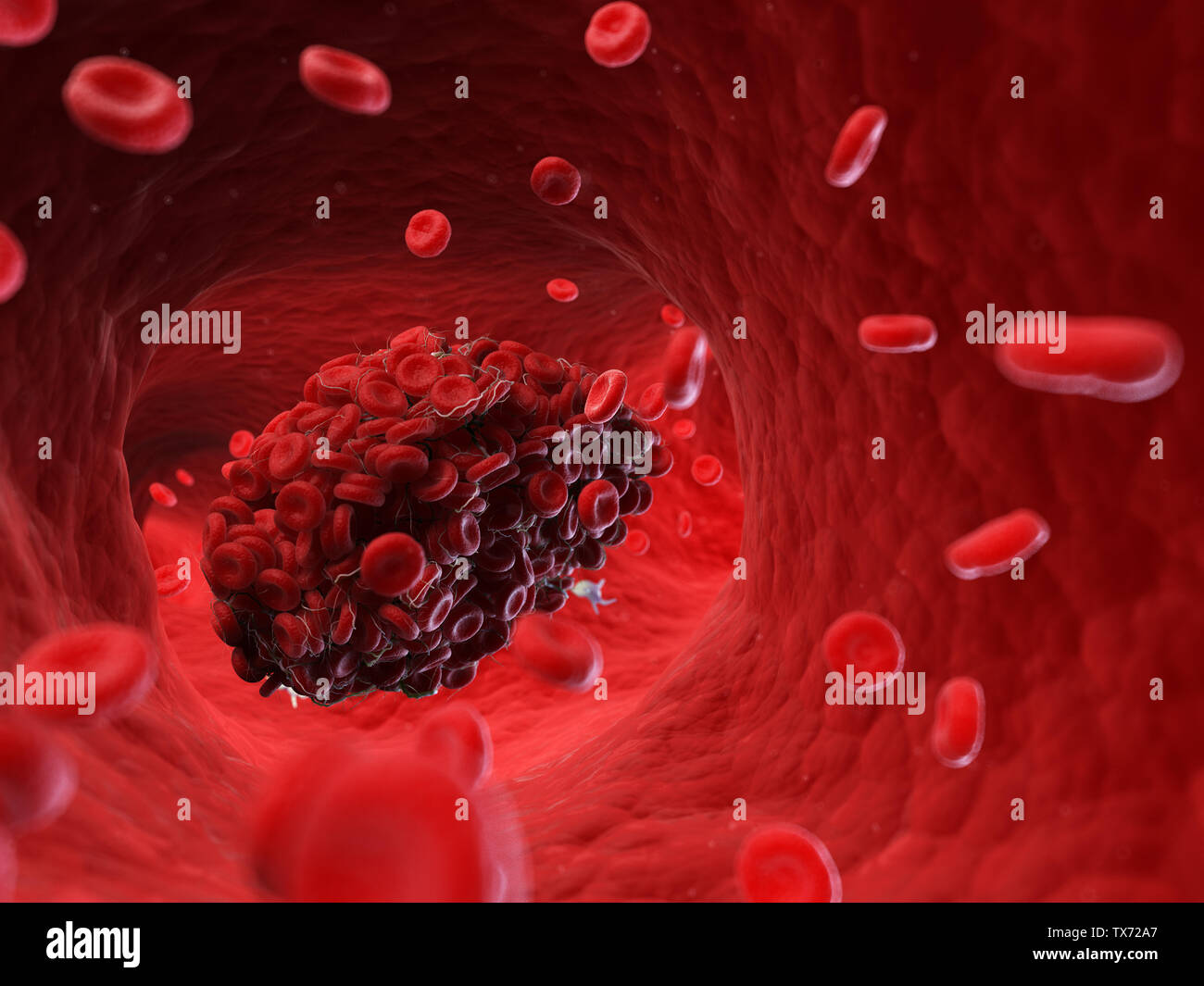 Médicalement, rendu 3d illustration précise d'un caillot de sang Banque D'Images
