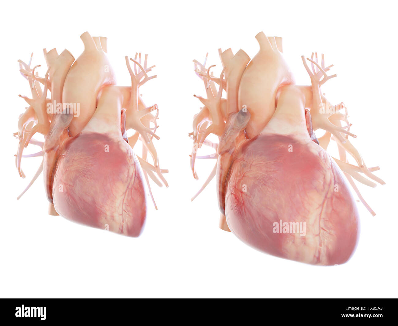 Médicalement, rendu 3d illustration précise d'une hypertrophie du coeur Banque D'Images