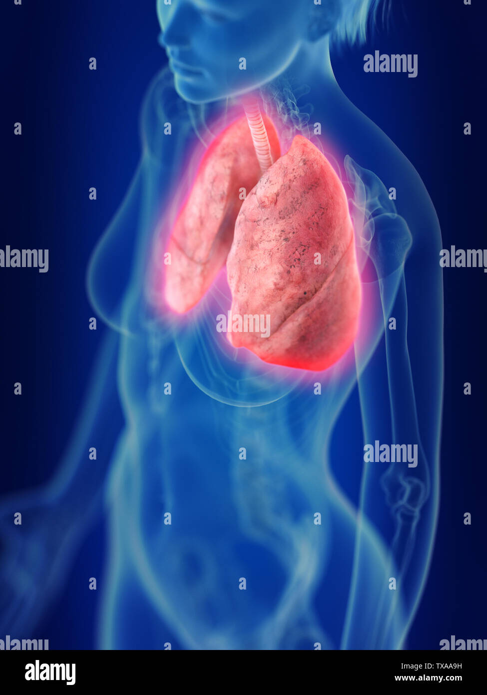 Médicalement en rendu 3d illustration d'une inflammation des poumons Banque D'Images