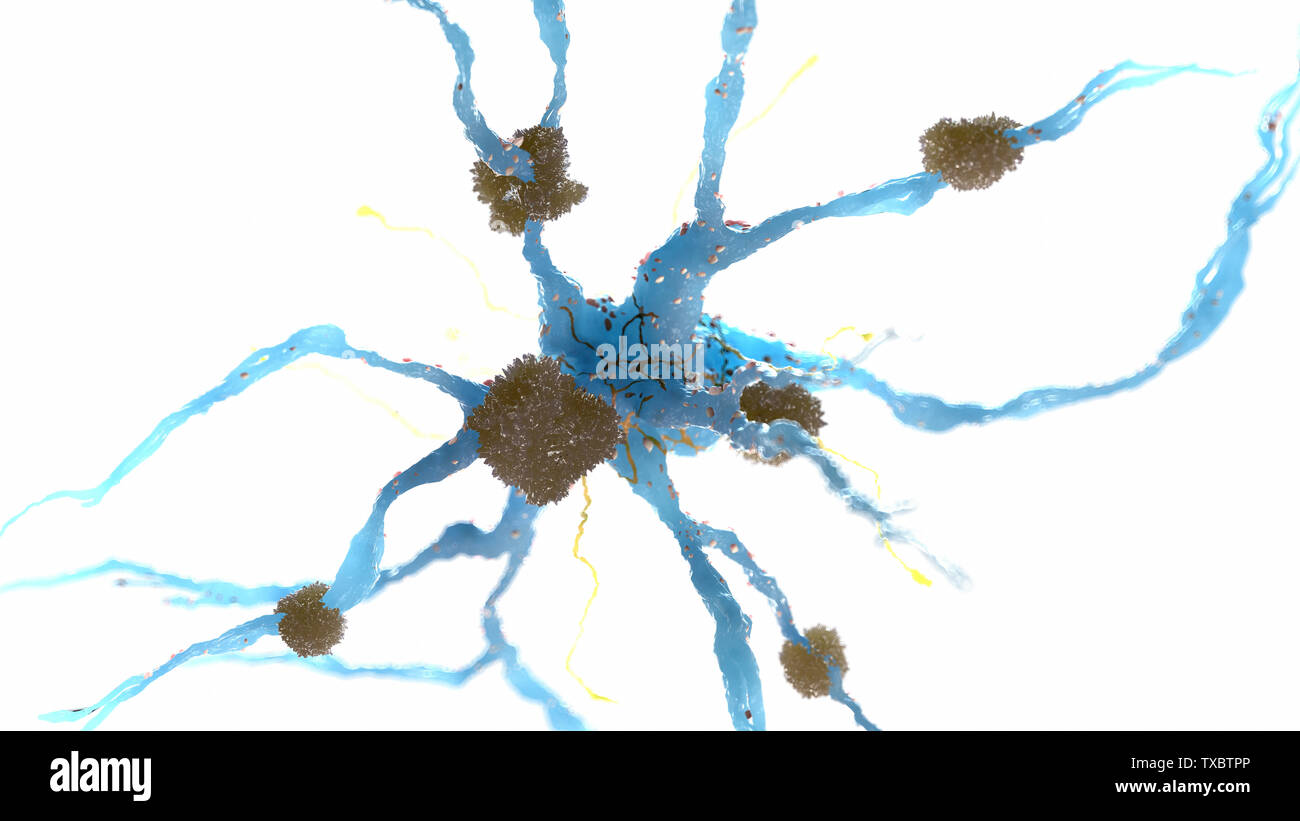 Médicalement en rendu 3d illustration précise de plaques amyloïdes sur une cellule nerveuse - la maladie d'alzheimer Banque D'Images