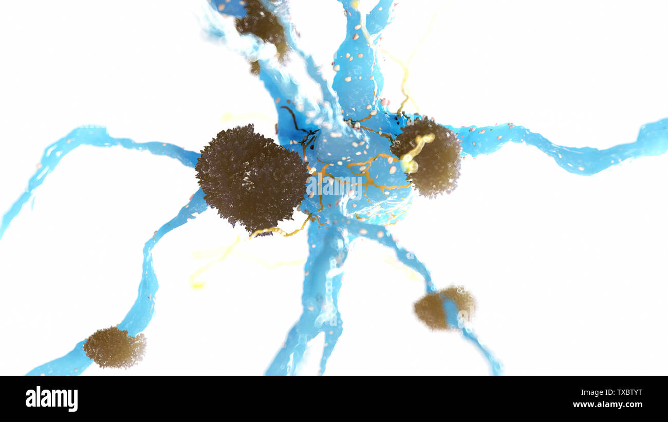 Médicalement en rendu 3d illustration précise de plaques amyloïdes sur une cellule nerveuse - la maladie d'alzheimer Banque D'Images