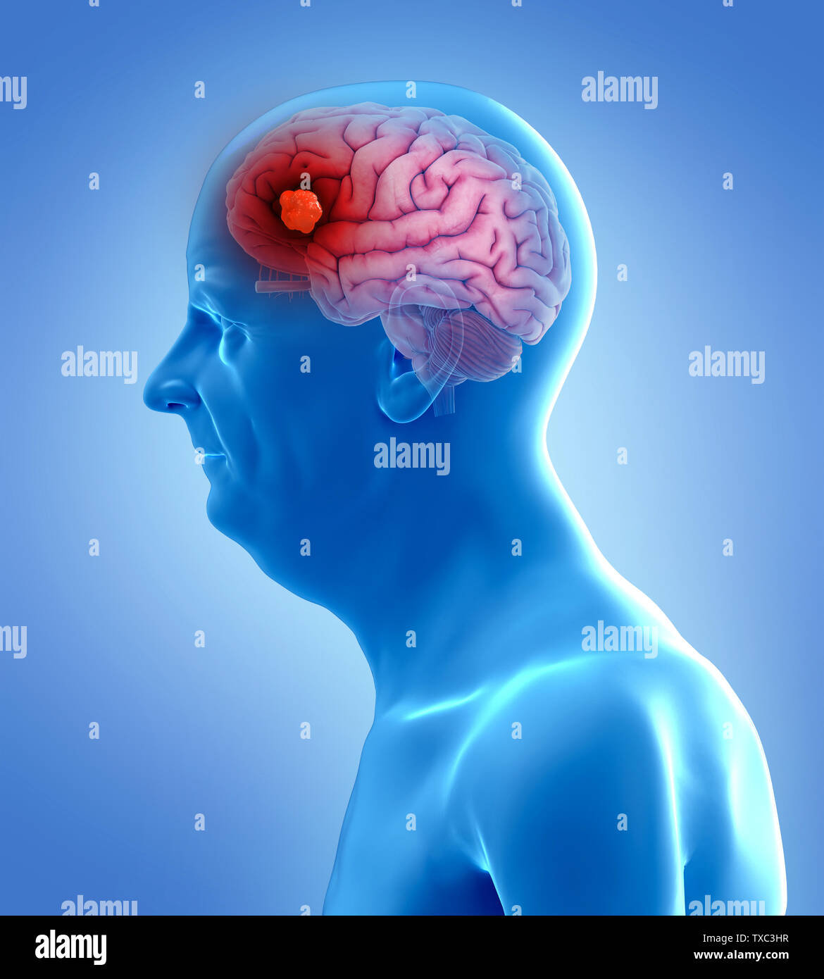 Médicalement, rendu 3d illustration précise d'une tumeur au cerveau Banque D'Images