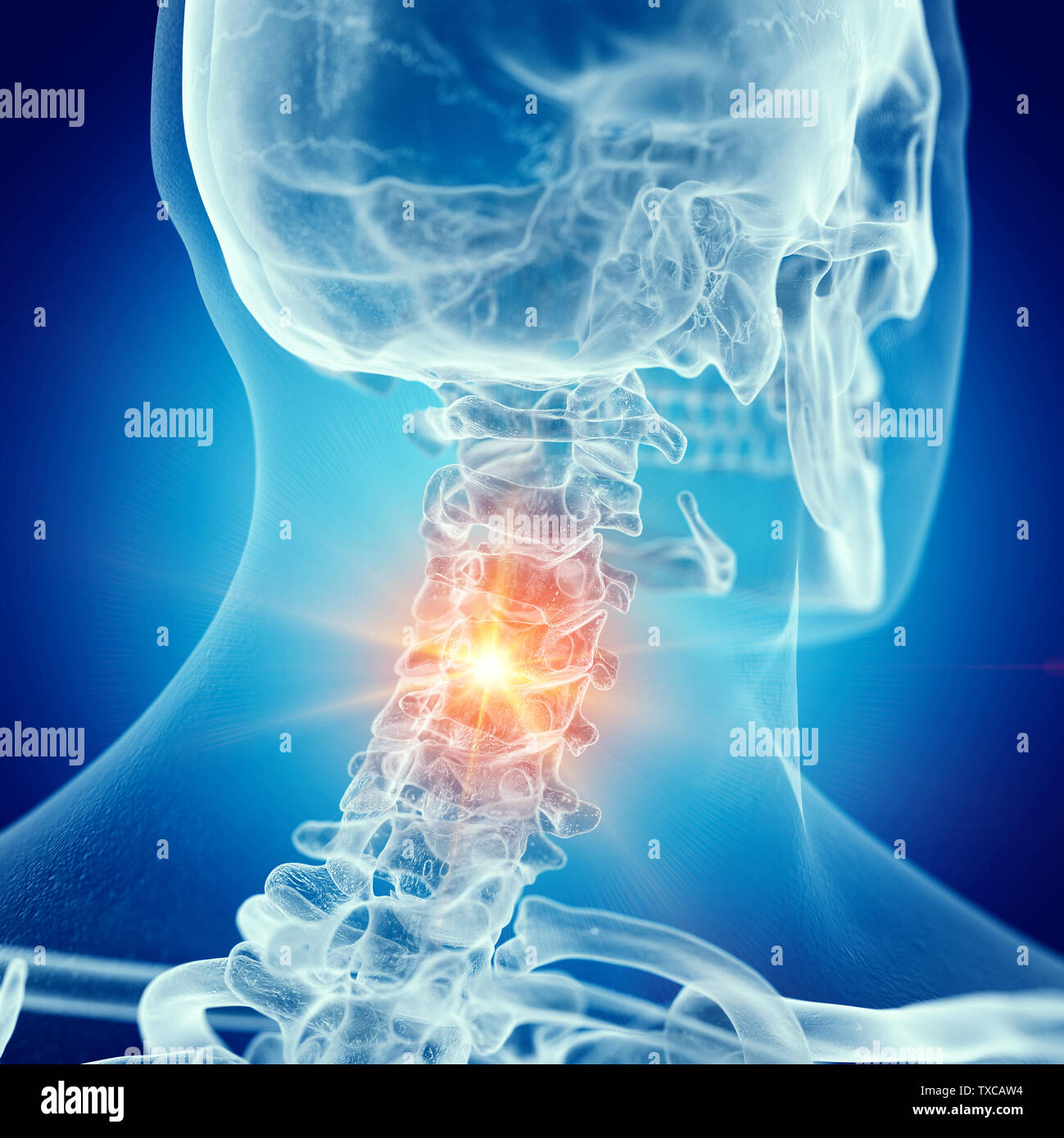 Rendu 3D précis médicalement illustration d'un rachis cervical douloureux Banque D'Images