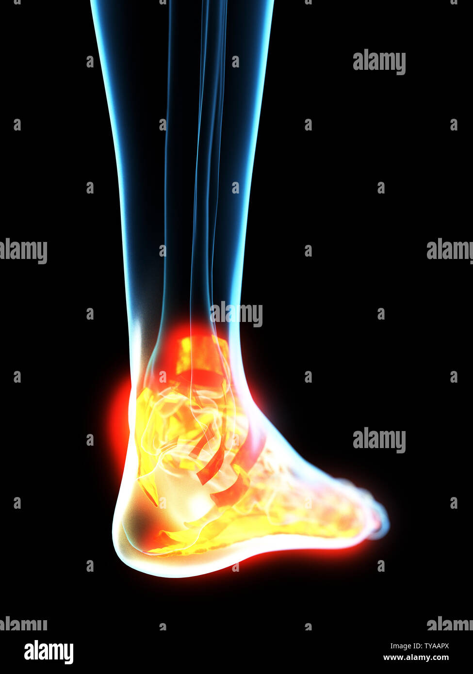 Médicalement en rendu 3d illustration de l'inflammation des ligaments précis Banque D'Images