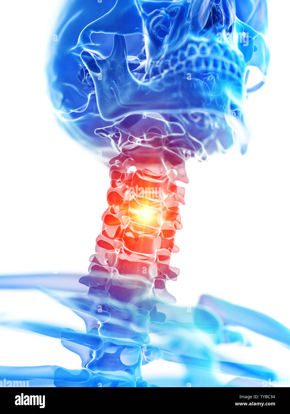 Rendu 3D précis médicalement illustration de la douleur cervicale cou montrant Banque D'Images