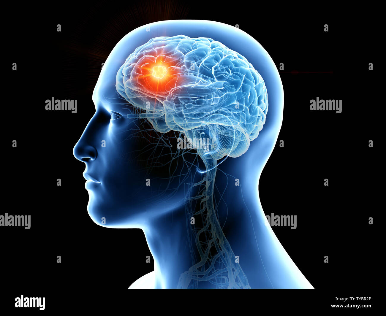 Médicalement en rendu 3d illustration précise du cerveau humain et d'une tumeur Banque D'Images