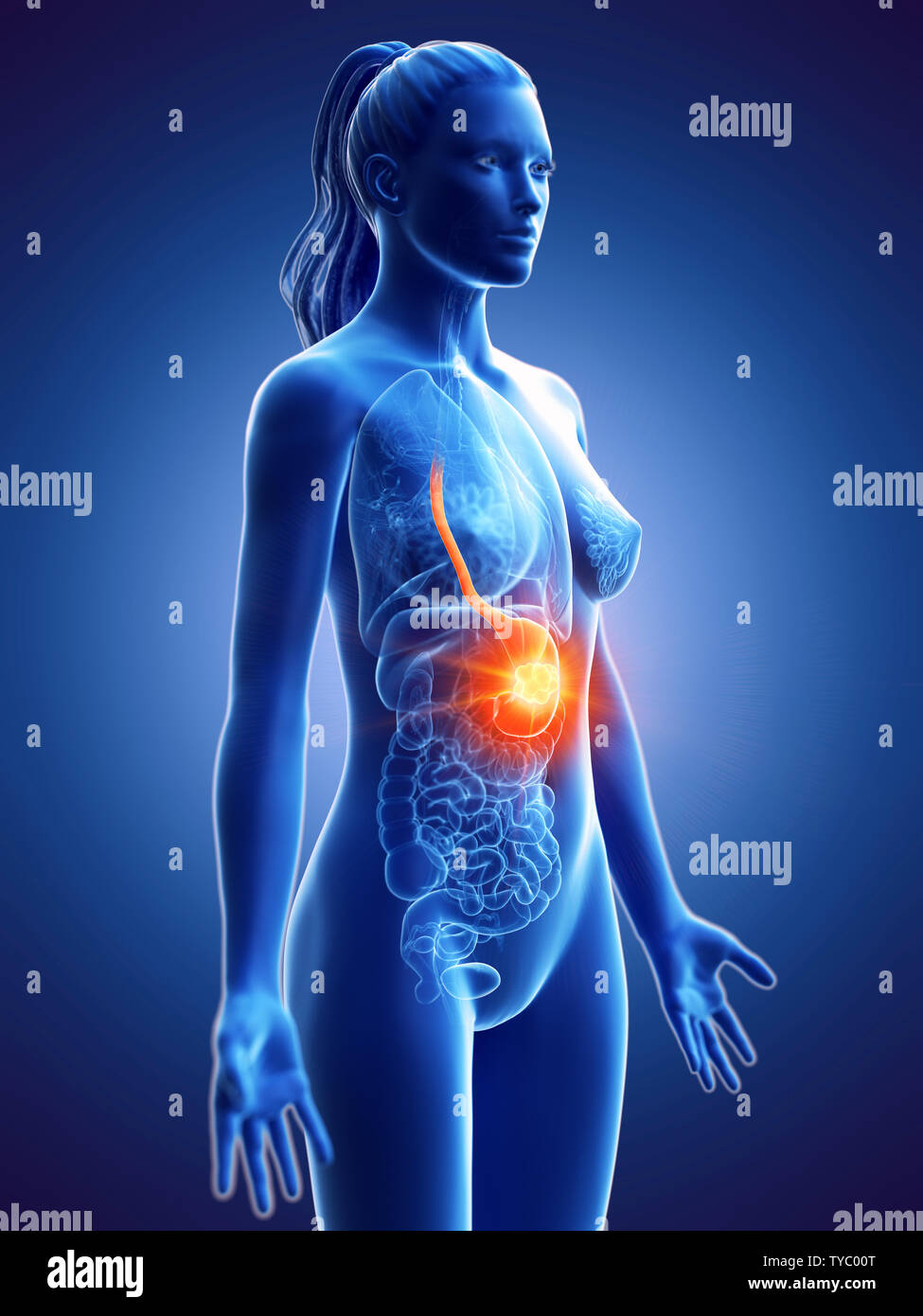 Rendu 3D précis médicalement illustration d'un cancer de l'estomac de womans Banque D'Images