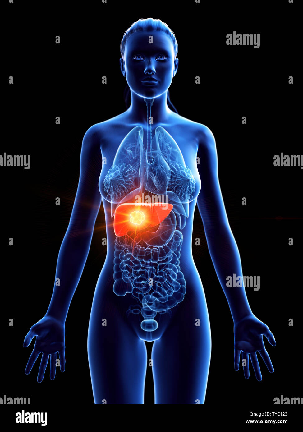 Rendu 3D précis médicalement illustration d'une tumeur au foie de womans Banque D'Images