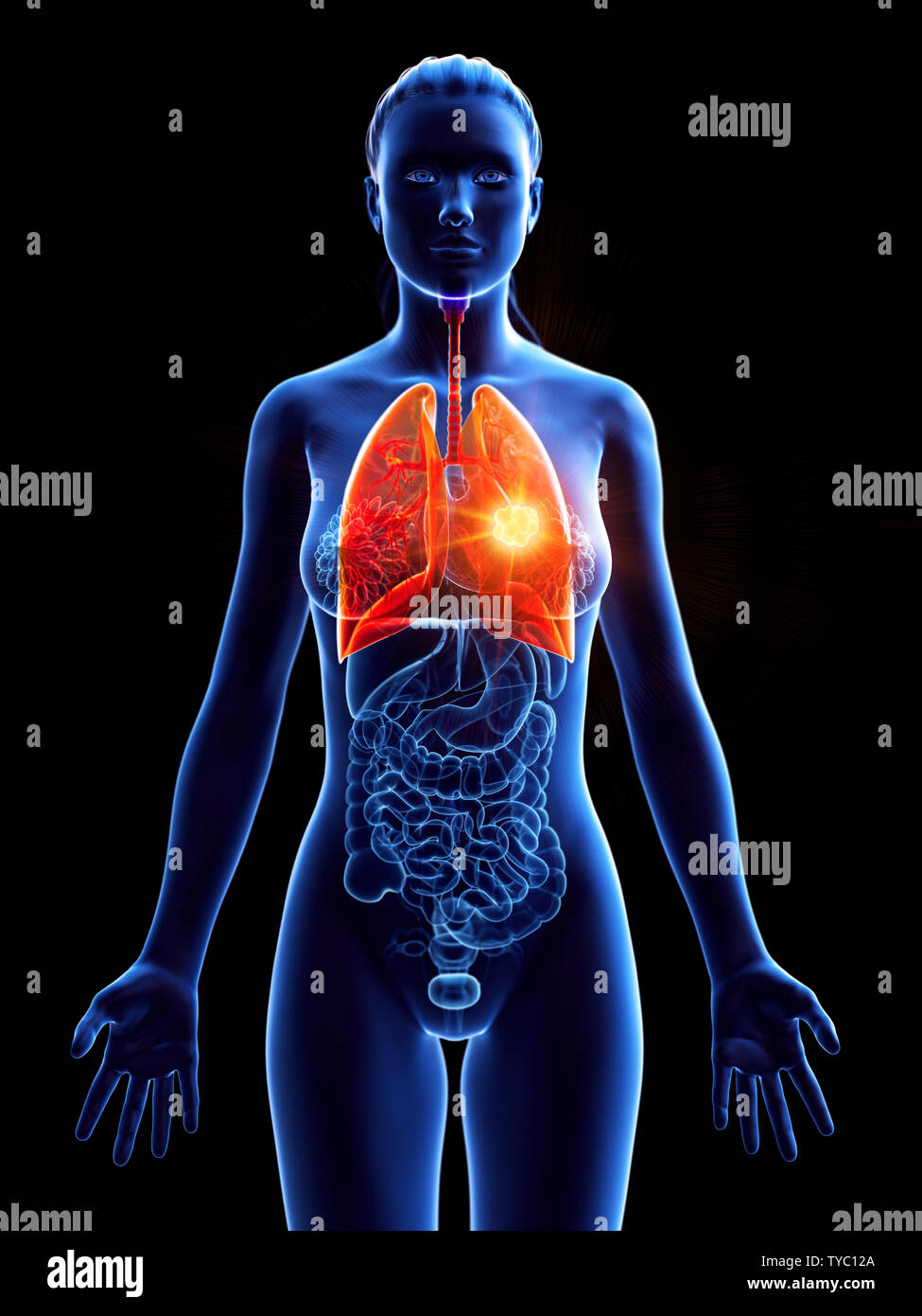 Rendu 3D précis médicalement illustration d'une tumeur pulmonaire womans Banque D'Images