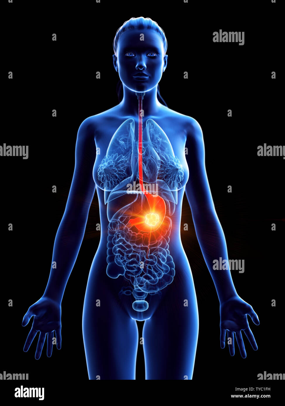 Rendu 3D précis médicalement illustration d'un cancer de l'estomac de womans Banque D'Images