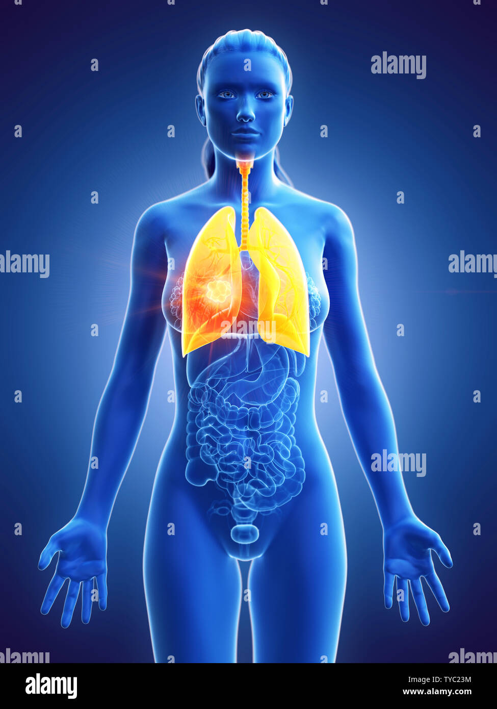 Rendu 3D précis médicalement illustration d'une tumeur pulmonaire womans Banque D'Images