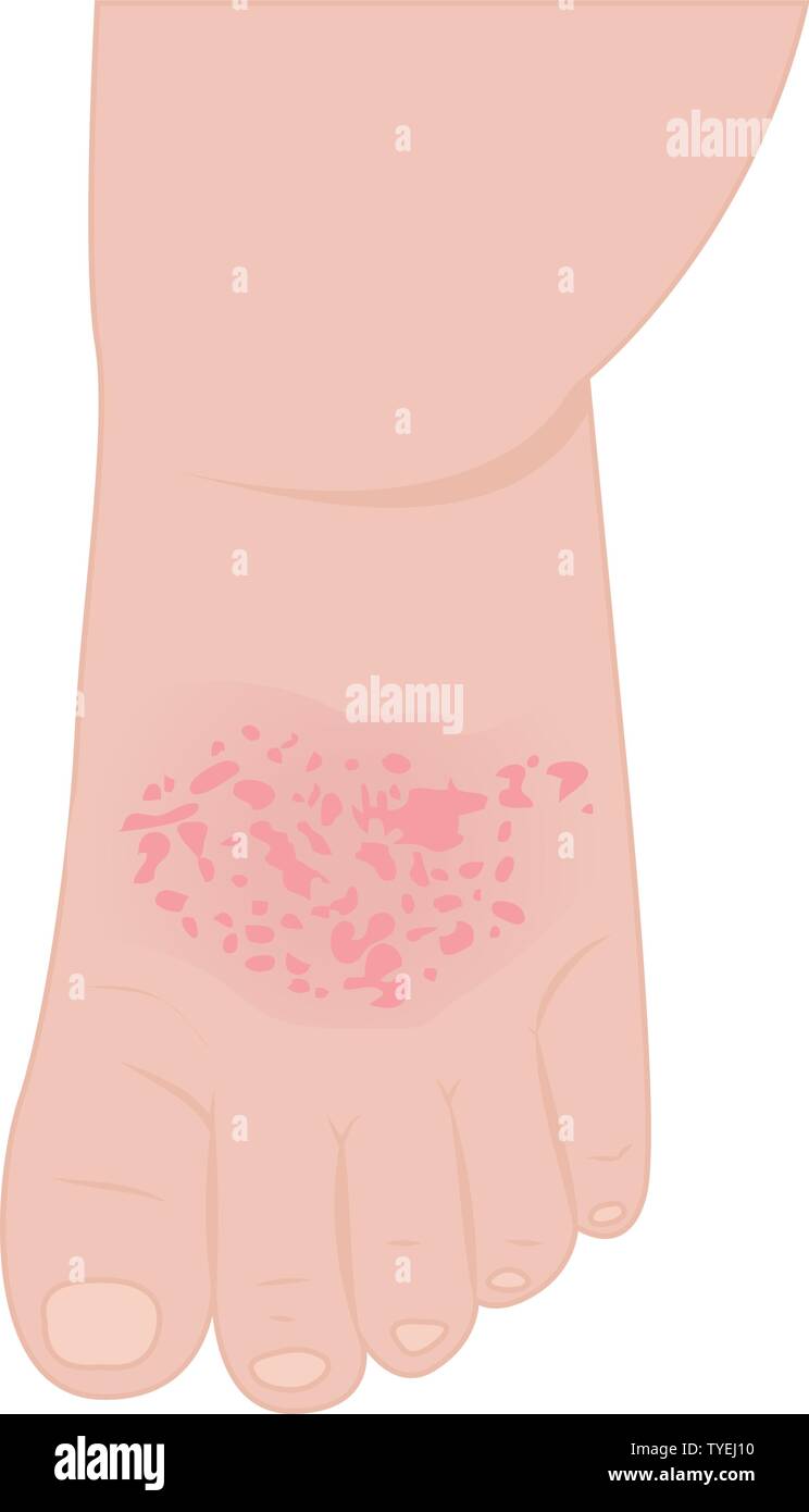 Un baby foot avec l'eczéma touchés vector illustration isolé sur fond blanc Illustration de Vecteur