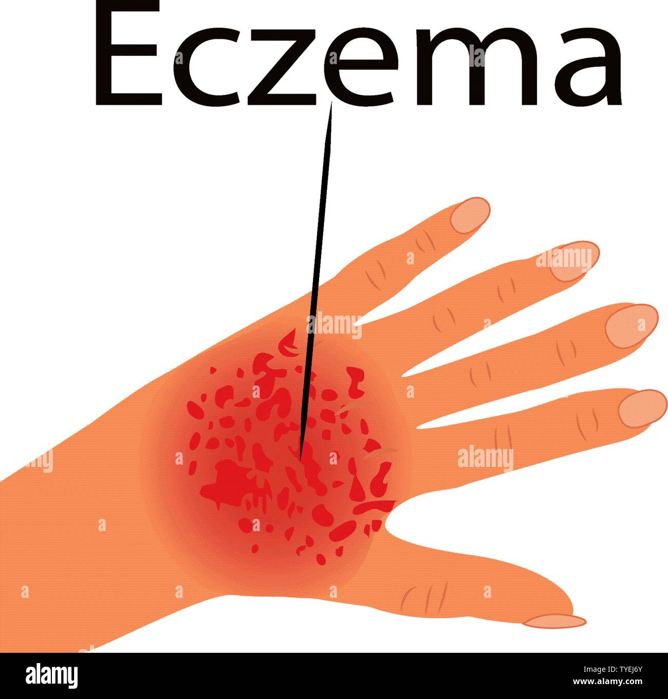 L'eczéma a affecté une part de dermatologie maladies de peau concept vector illustration isolé