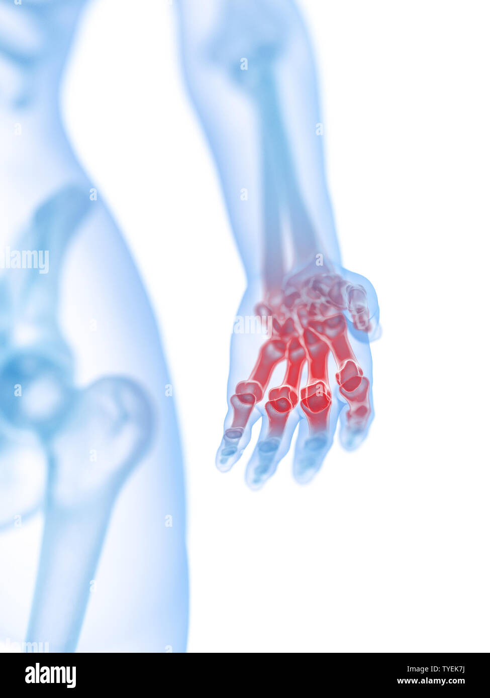 Rendu 3D précis médicalement illustration d'une main douloureuse Banque D'Images