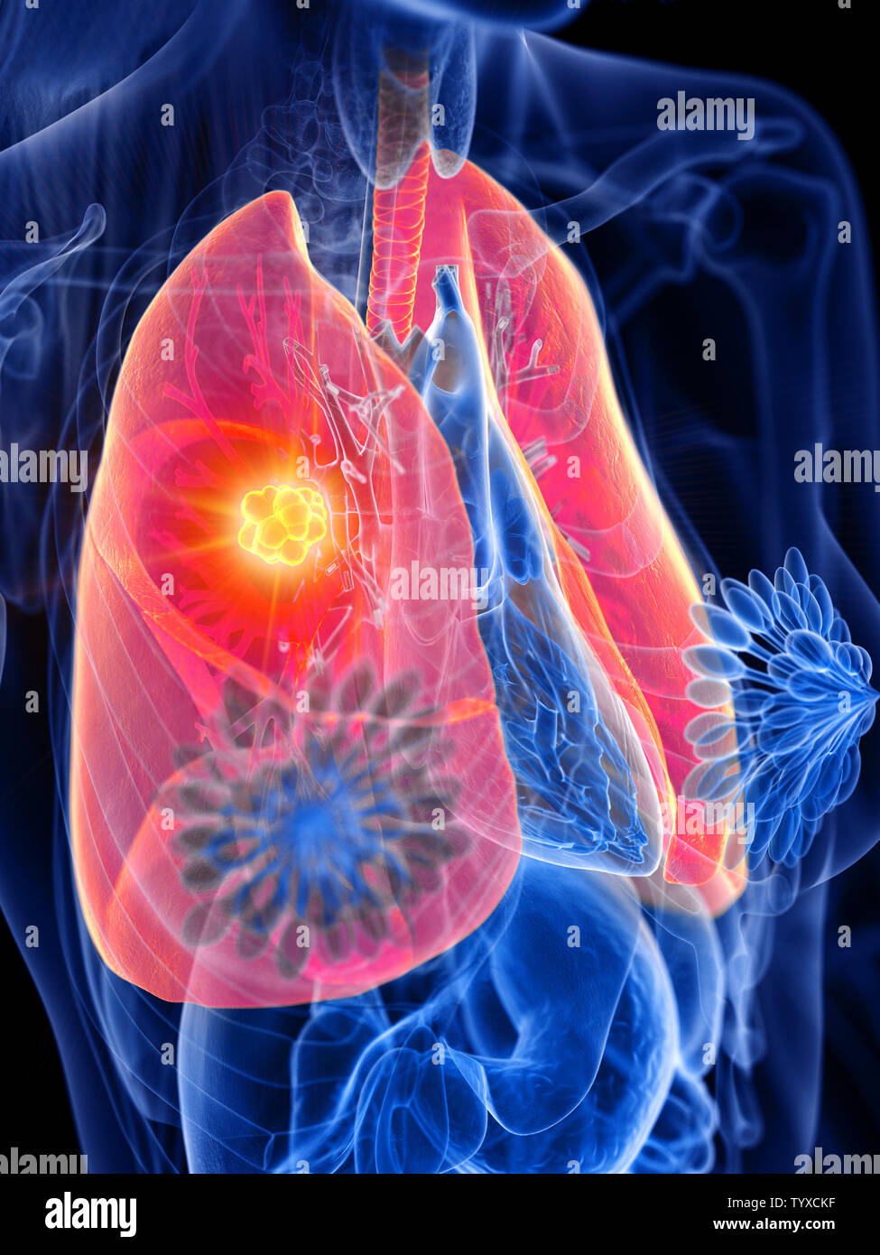 Rendu 3D précis médicalement illustration d'une tumeur pulmonaire womans Banque D'Images
