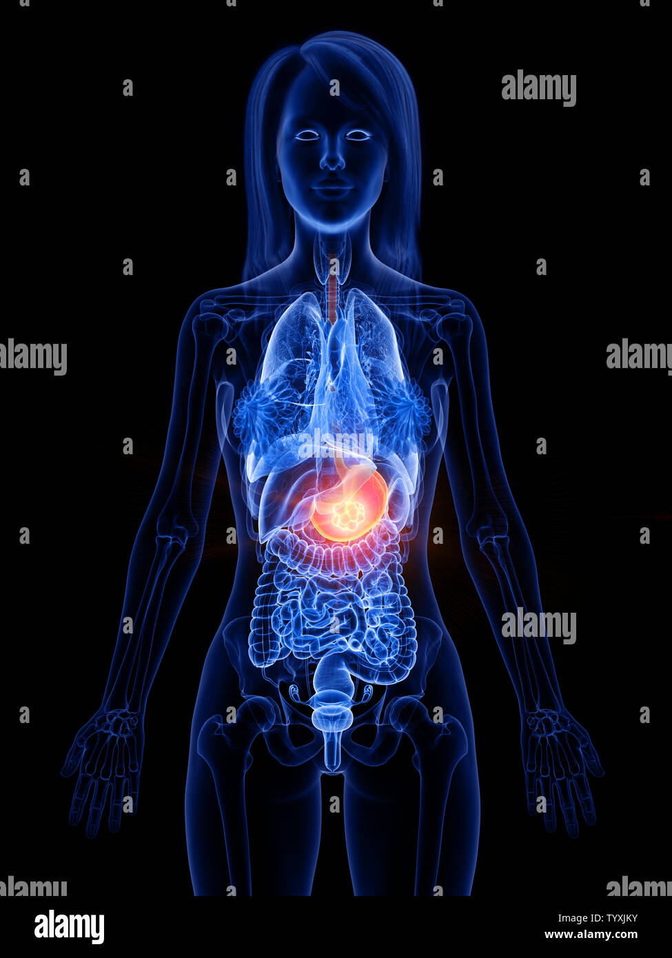 Rendu 3D précis médicalement illustration d'une tumeur à l'estomac de womans Banque D'Images