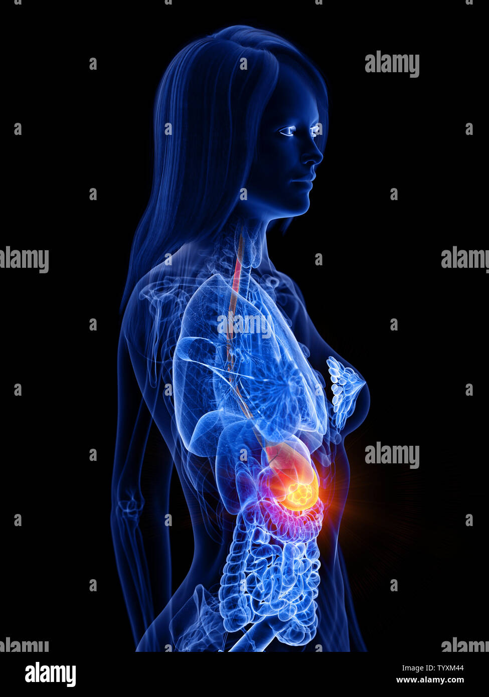 Rendu 3D précis médicalement illustration d'une tumeur à l'estomac de womans Banque D'Images