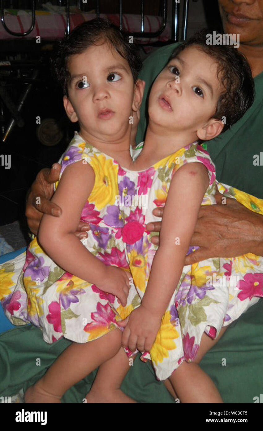 One-year-old jumeaux siamois Stuti et Aradhna apparaissent à un hôpital à Betul, Madhya Pradesh, Inde le 19 juin 2012. Les jumeaux, qui ont été jointes à la poitrine, ont été séparés hier à 12 heures d'opération impliquant 23 médecins et 11 infirmières de l'Inde et l'Australie. . UPI/ Str.. Banque D'Images