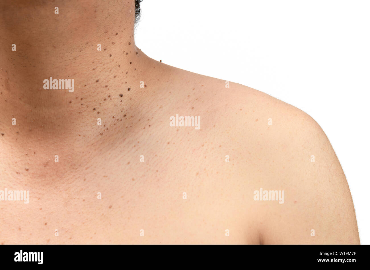 Fermé le haut de la peau tags ou kératose séborrhéique sur cou homme isolé sur fond blanc.Le concept de soins de santé Banque D'Images