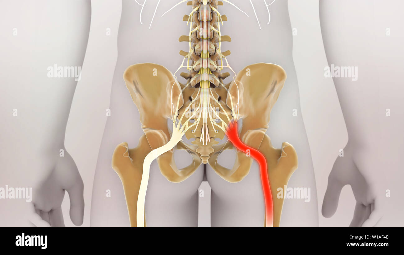 La douleur du nerf sciatique Banque D'Images