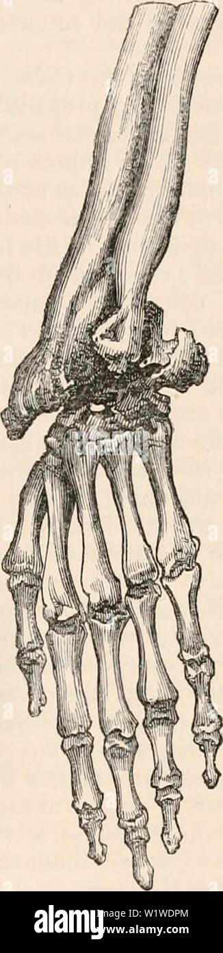 Image d'archive à partir de la page 740 de la cyclopaedia de l'anatomie et. La cyclopaedia de l'anatomie et physiologie0402cyclopdiaofana todd Année : 1849-POIGNET ANATOMIE anormale (mixte). 1525 avec la région fistuleuse de canaux, les orifices qui con- purulent conduit d'affaire des centres d'une partie de l'os, curieux et de l'interstice entre eux. À cette période de la maladie que nous pouvons, en maintenant la partie inférieure de l'avant-bras avec une main, et tenant le métacarpe de l'autre, ces pièces se déplacent latéralement dans des directions opposées, clairement s'assurer que tous les os sont lâches et de caries, et dans un irreco Banque D'Images