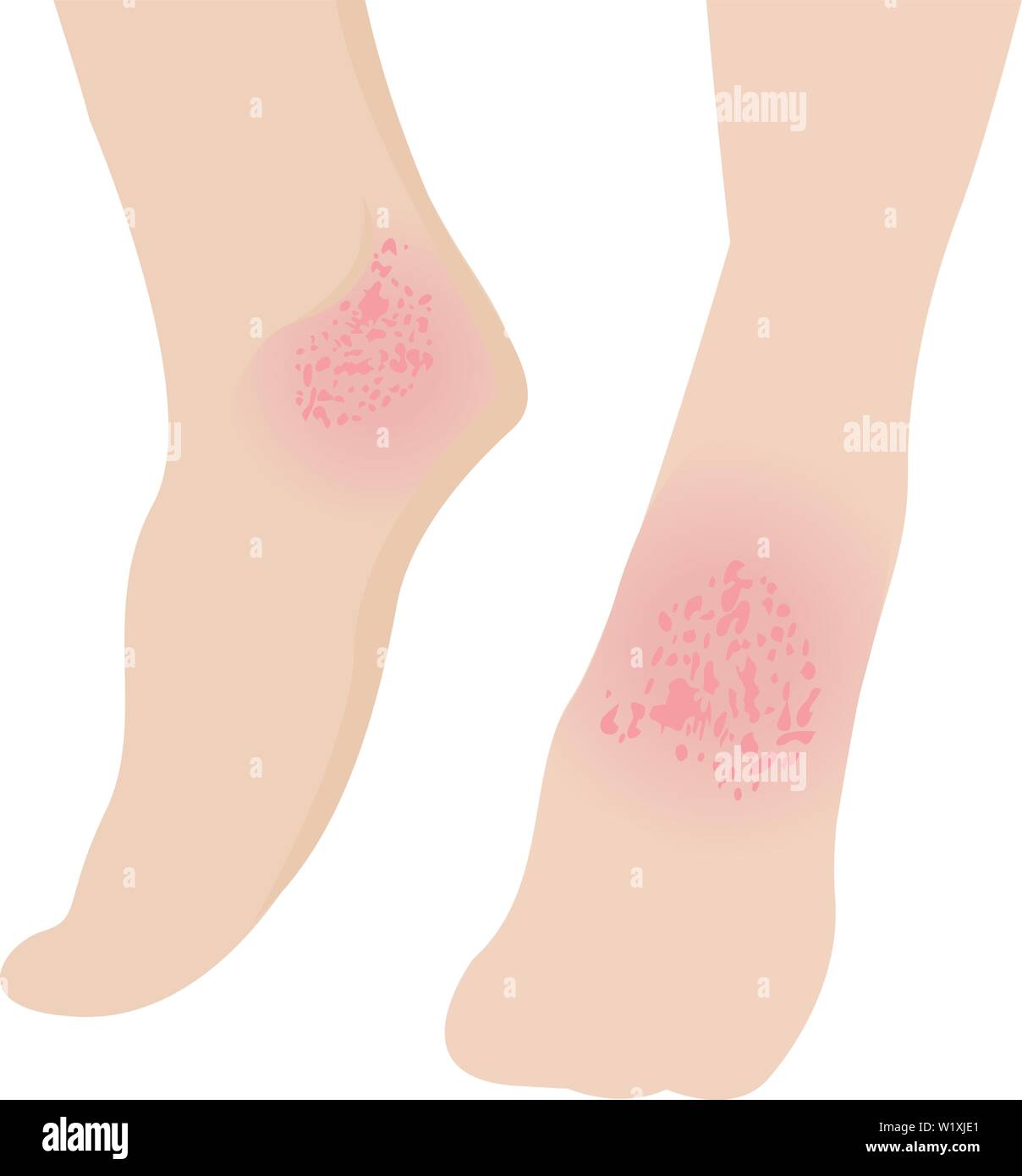 L'eczéma affecte un pied Dermatologie maladies de peau concept vector illustration isolé sur fond blanc Illustration de Vecteur