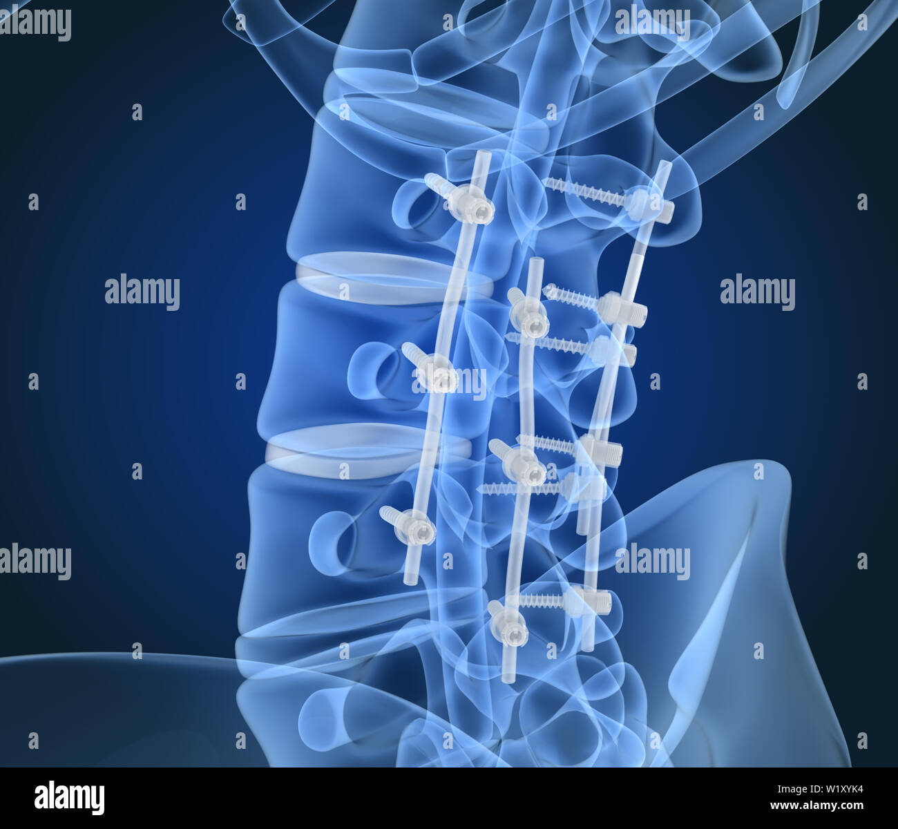 Système de fixation de la colonne vertébrale - titane support. La vue X-ray. 3D illustration Banque D'Images