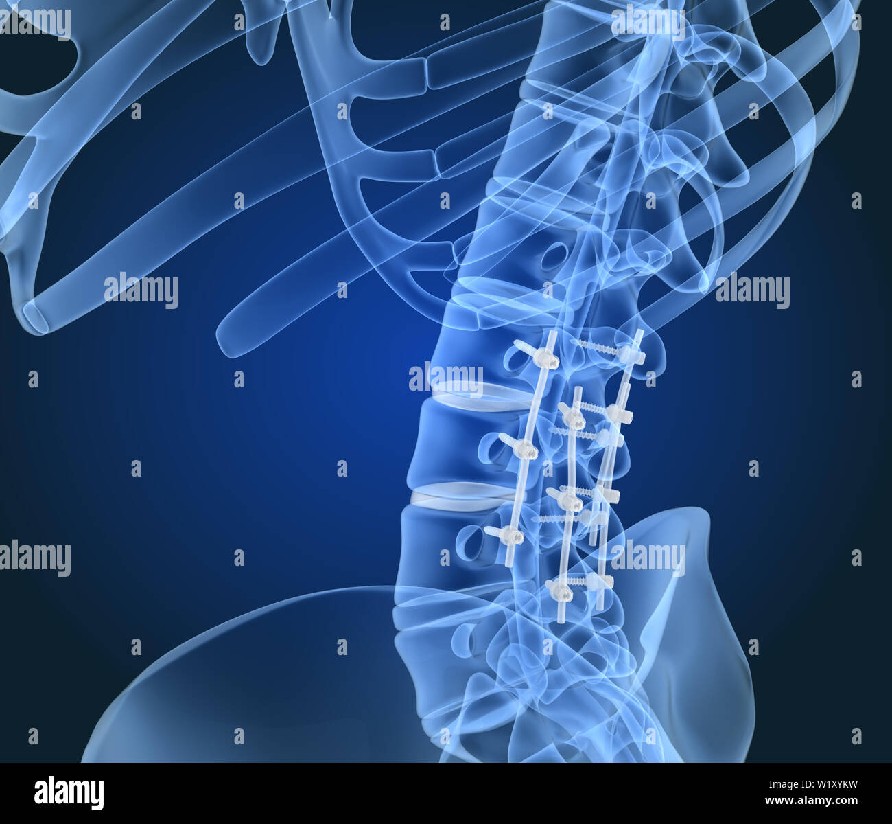 Système de fixation de la colonne vertébrale - titane support. La vue X-ray. 3D illustration Banque D'Images
