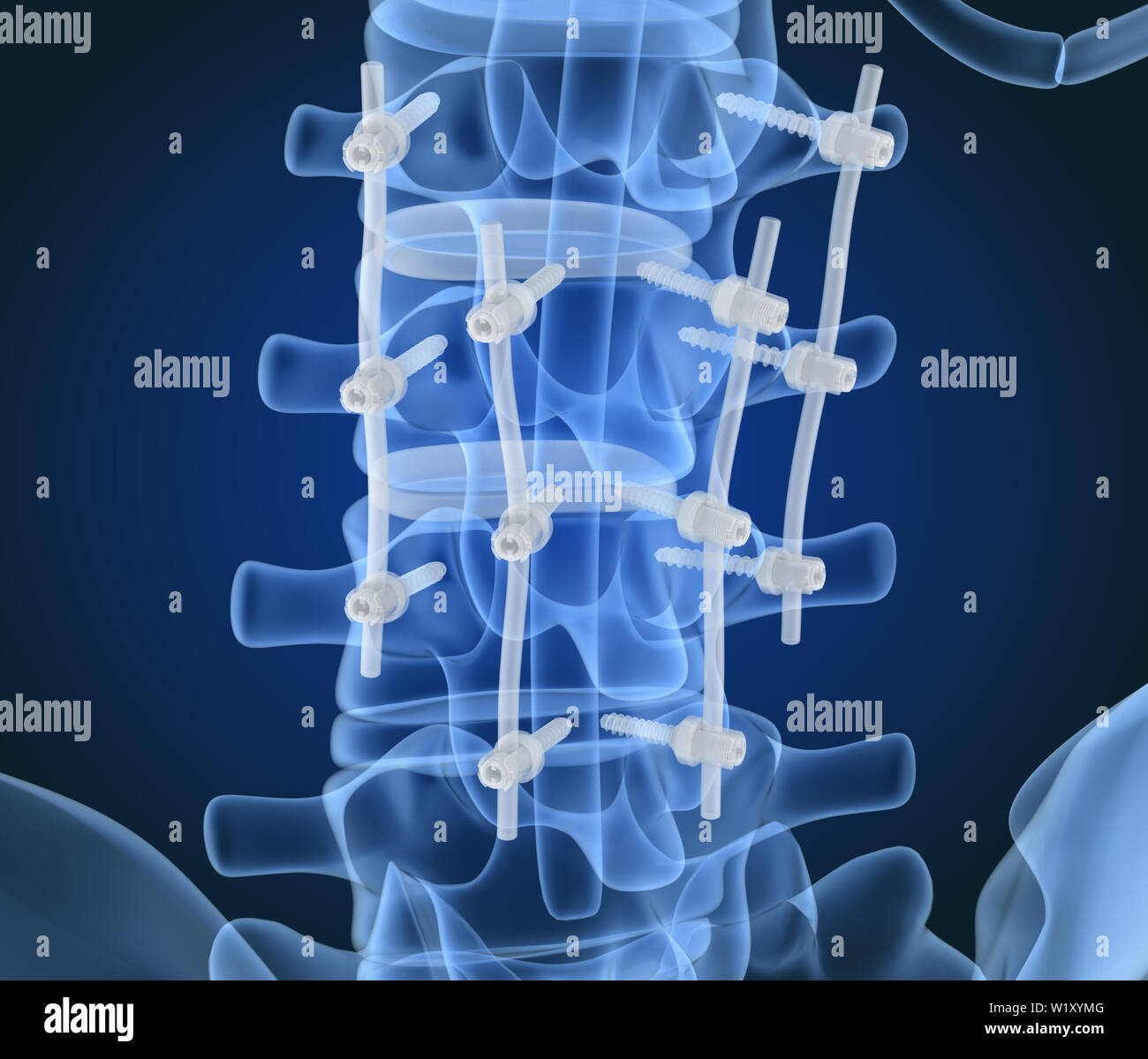 Système de fixation de la colonne vertébrale - titane support. La vue X-ray. 3D illustration Banque D'Images