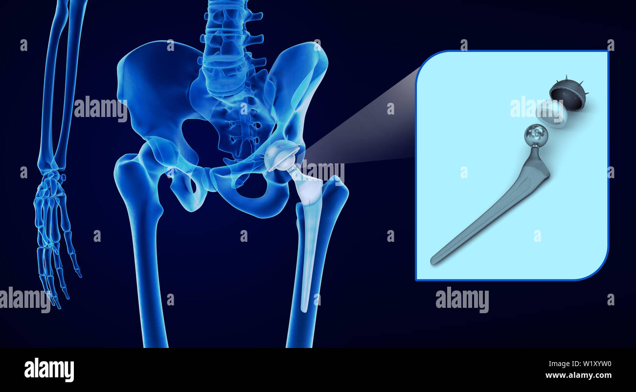 Remplacement de la hanche implant dans l'os du bassin. La vue X-ray. Illustration 3D précis médicalement Banque D'Images