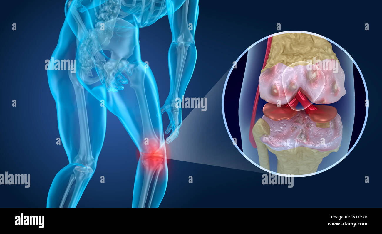 Attaque de la douleur au genou, l'homme souffrant de genou. 3D illustration Banque D'Images