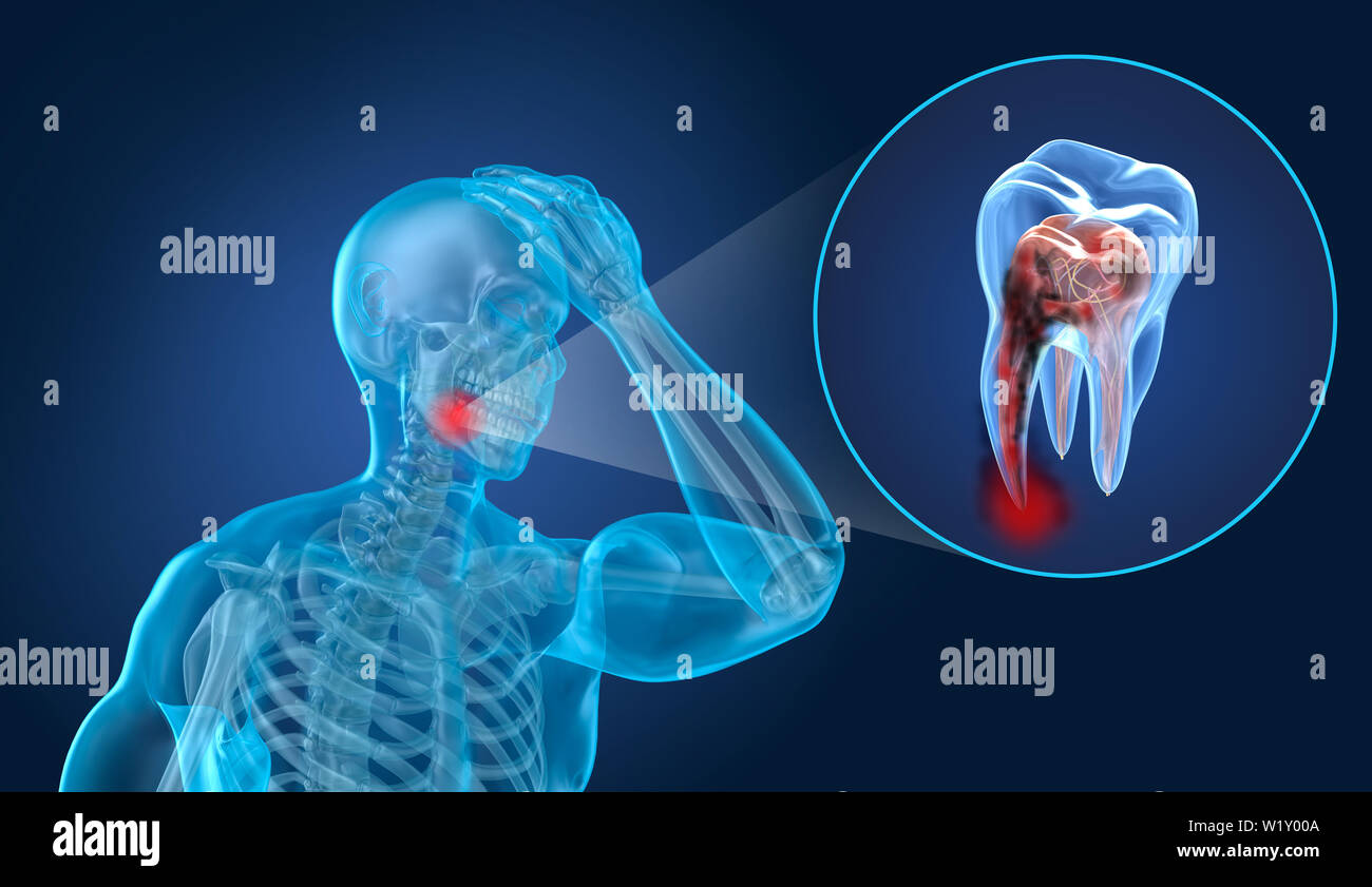La douleur des dents, l'homme souffrant de la douleur des dents. 3D illustration Banque D'Images
