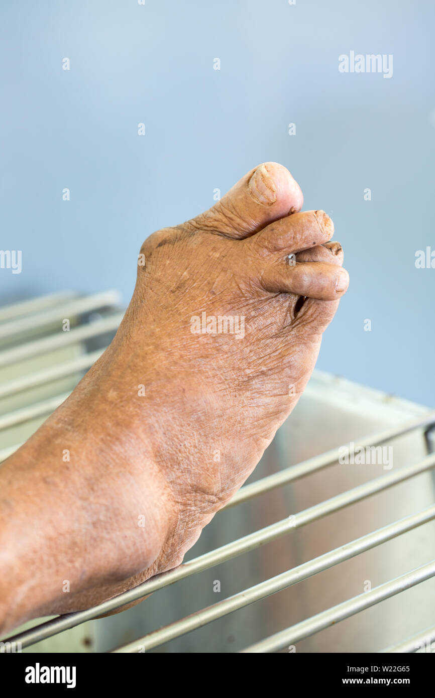 Pied déformé par l'arthrite rhumatoïde Banque D'Images