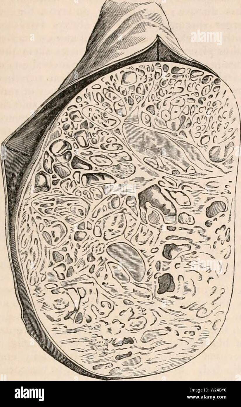 Image d'archive à partir de la page 226 de la cyclopaedia de l'anatomie et. La cyclopaedia de l'anatomie et physiologie0402cyclopdiaofana todd Année : 1849 (TESTICULE ANATOMIE anormale). développé sous deux formes. Dans l'un, il se produit en association avec careinomatous- : Fig. 654. Section d'une tumeur kystique du testicule, montrant une multitude de kystes de diverses formes et tailles, avec la matière solide interposé entre eux. La structure glandulaire est icholly détruit. dans l'autre et forme plus courante, la tumeur est d'un caractère innocent, et exempts de la maladie risque de s'attaquer à d'autres parties d'une Banque D'Images