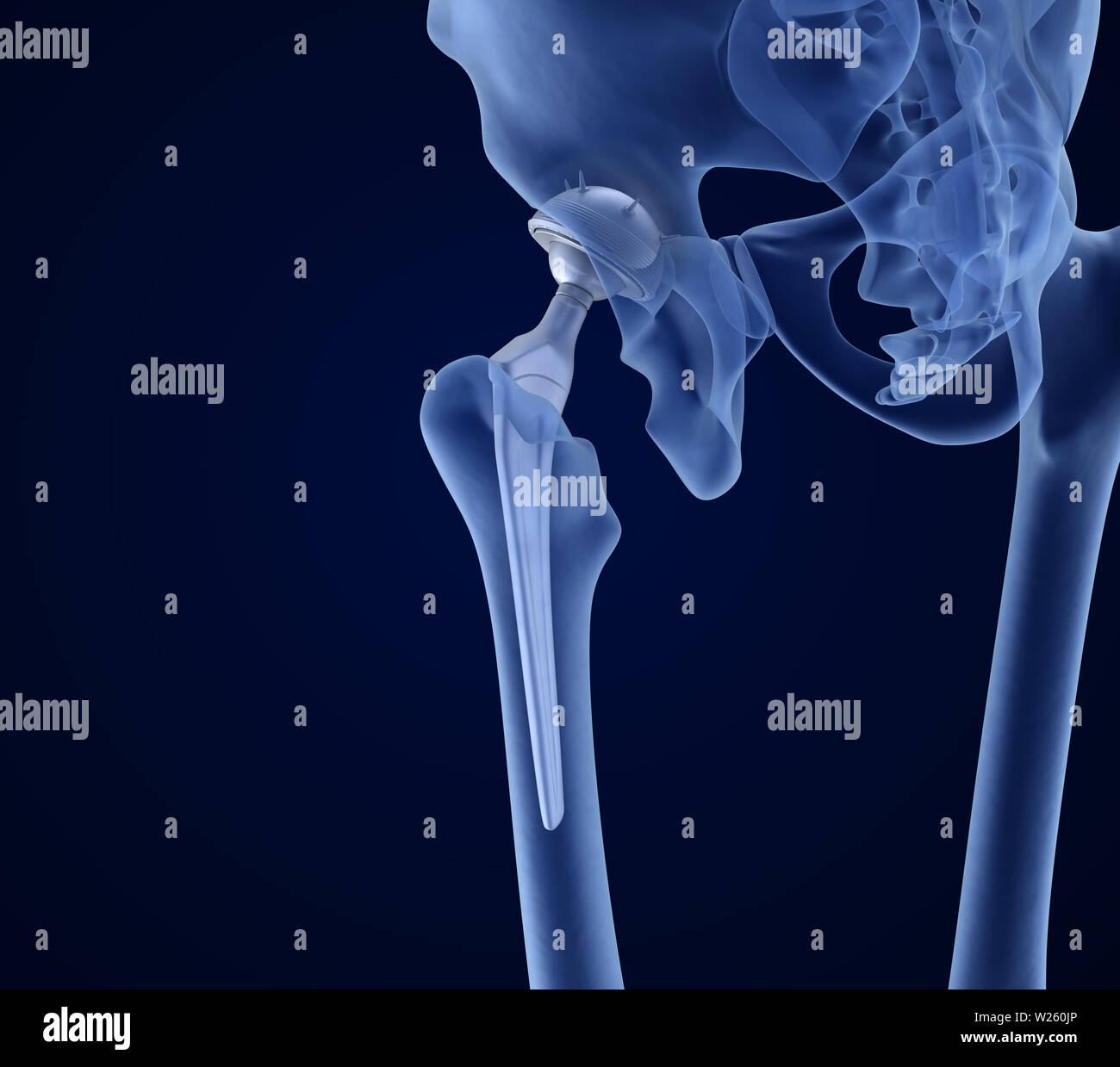 Remplacement de la hanche implant dans l'os du bassin. La vue X-ray. Illustration 3D précis médicalement Banque D'Images