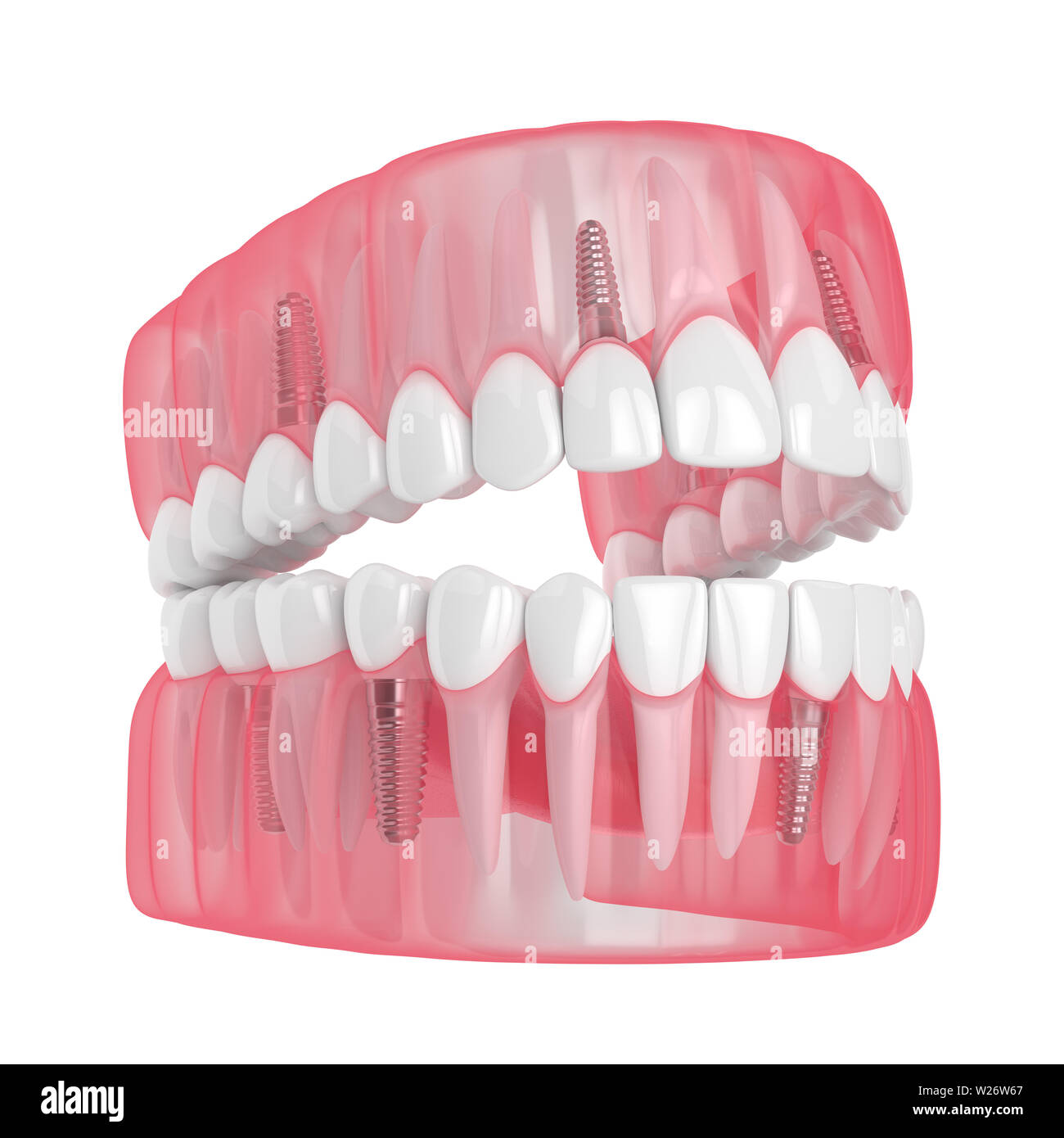 Mâchoire de rendu 3D avec les implants dentaires isolé sur fond blanc Banque D'Images