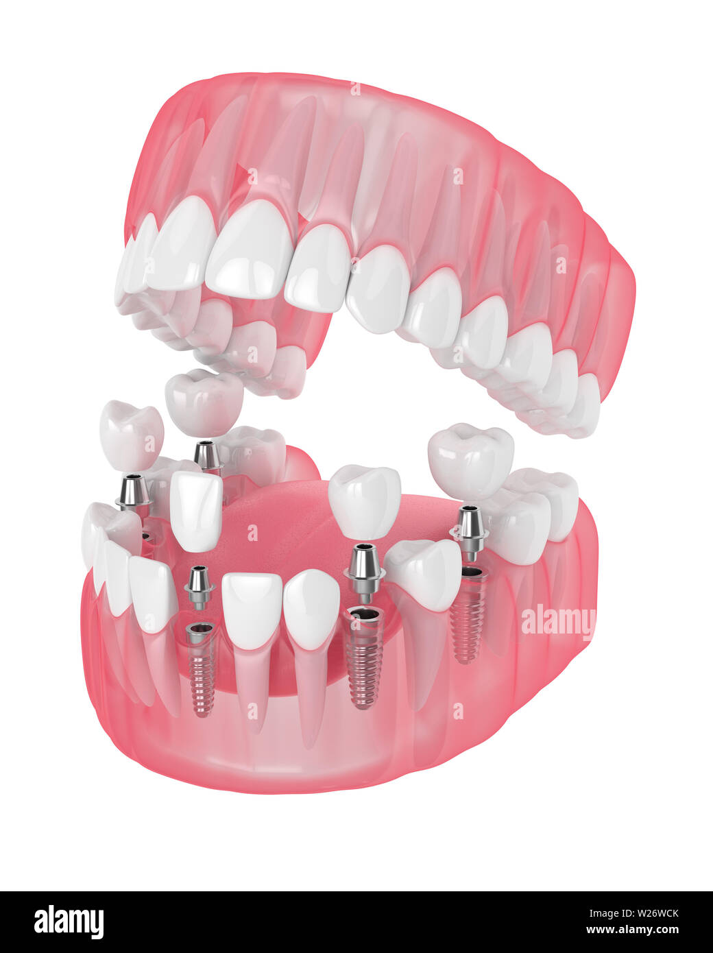 Mâchoire de rendu 3D avec les implants dentaires isolé sur fond blanc Banque D'Images