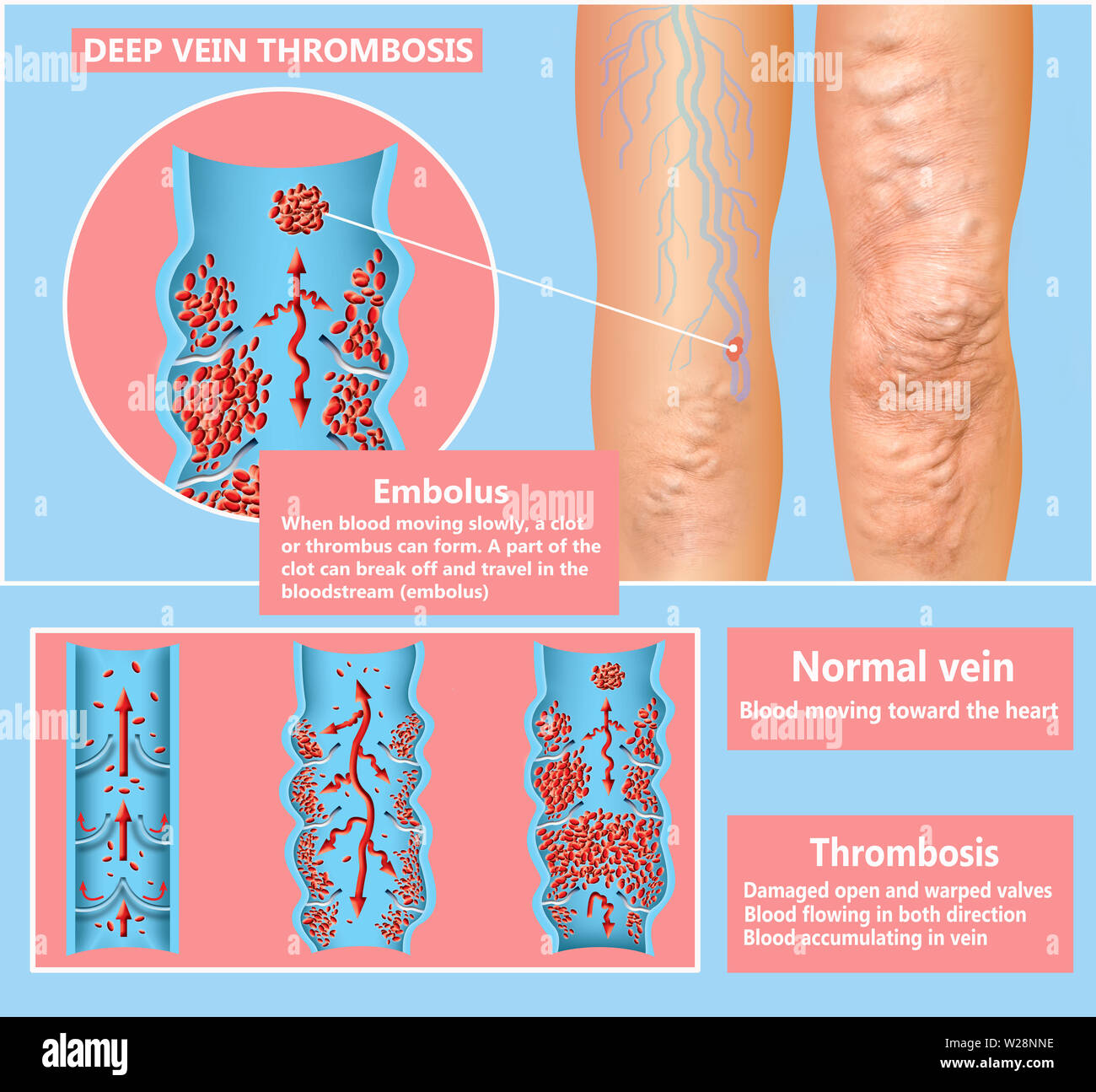 Thrombose veineuse profonde ou des caillots de sang. Embolie gazeuse. Structure de la normale et les varices des veines de sexe féminin. L'illustration a été créé par moi Banque D'Images