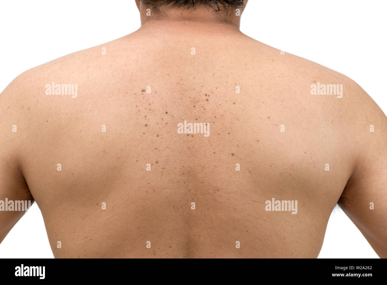 Fermé le haut de la peau tags ou kératose séborrhéique retour sur l'homme isolé sur fond blanc.Le concept de soins de santé Banque D'Images