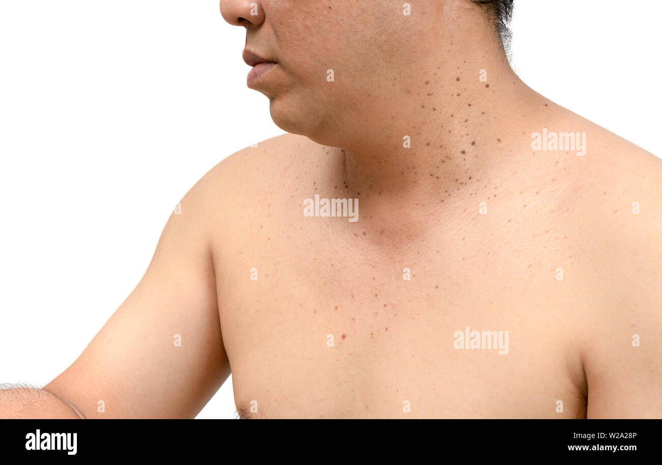 Fermé le haut de la peau tags ou kératose séborrhéique sur cou homme isolé sur fond blanc.Le concept de soins de santé Banque D'Images