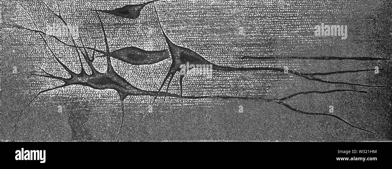 SMO V12 D652 masses malades montrant dans une section du bulbe rachidien Banque D'Images