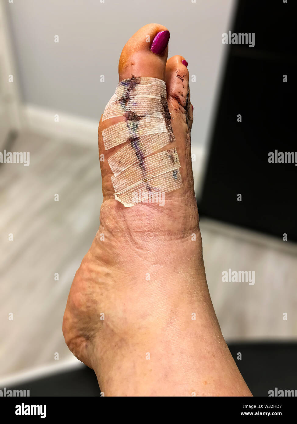 Jour 10 Après l'oignon et la chirurgie de hammertoe, juste avant les points de suture ont été supprimés. Banque D'Images