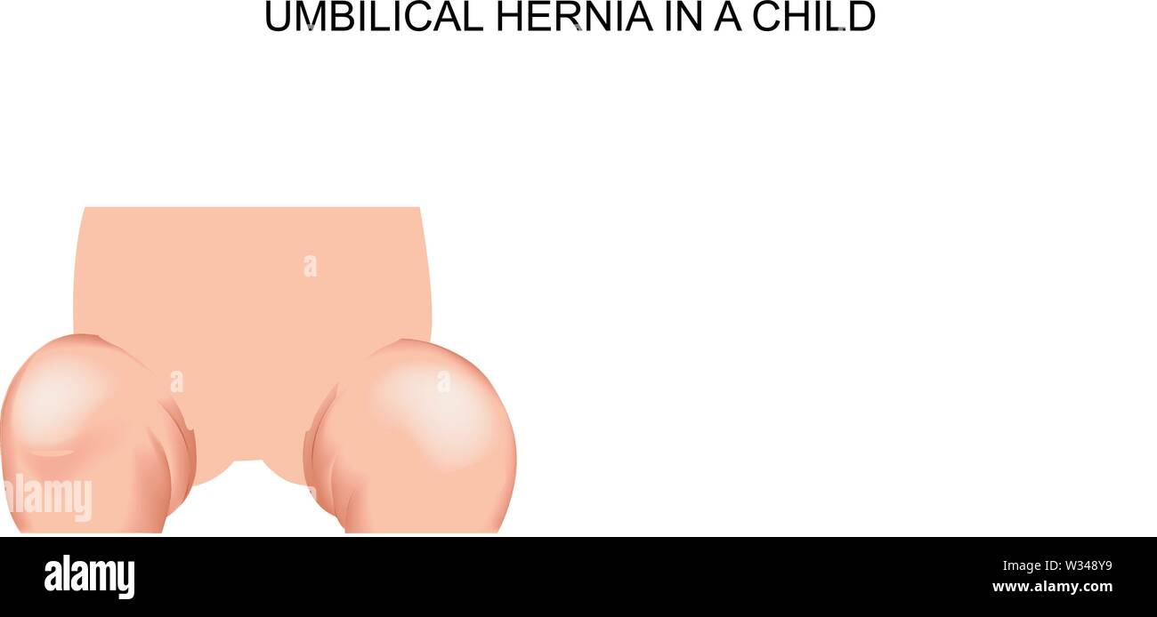 Hernie Ombilicale Banque D Image Et Photos Alamy