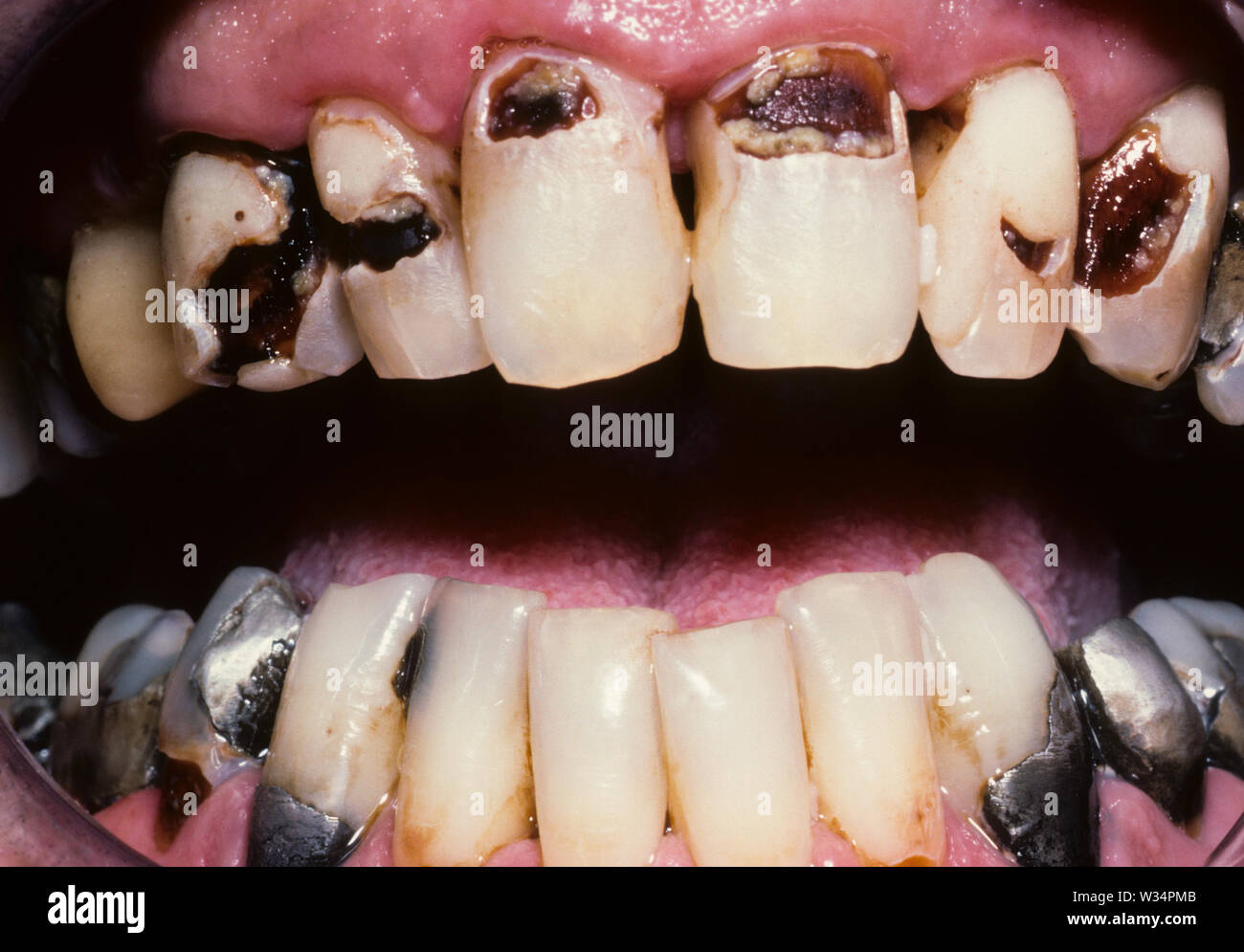 Caries Dentaires Banque D Image Et Photos Alamy