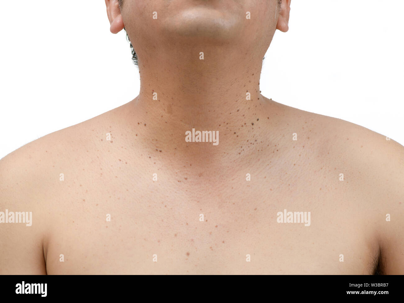 Fermé le haut de la peau tags ou kératose séborrhéique sur cou homme isolé sur fond blanc.Le concept de soins de santé Banque D'Images
