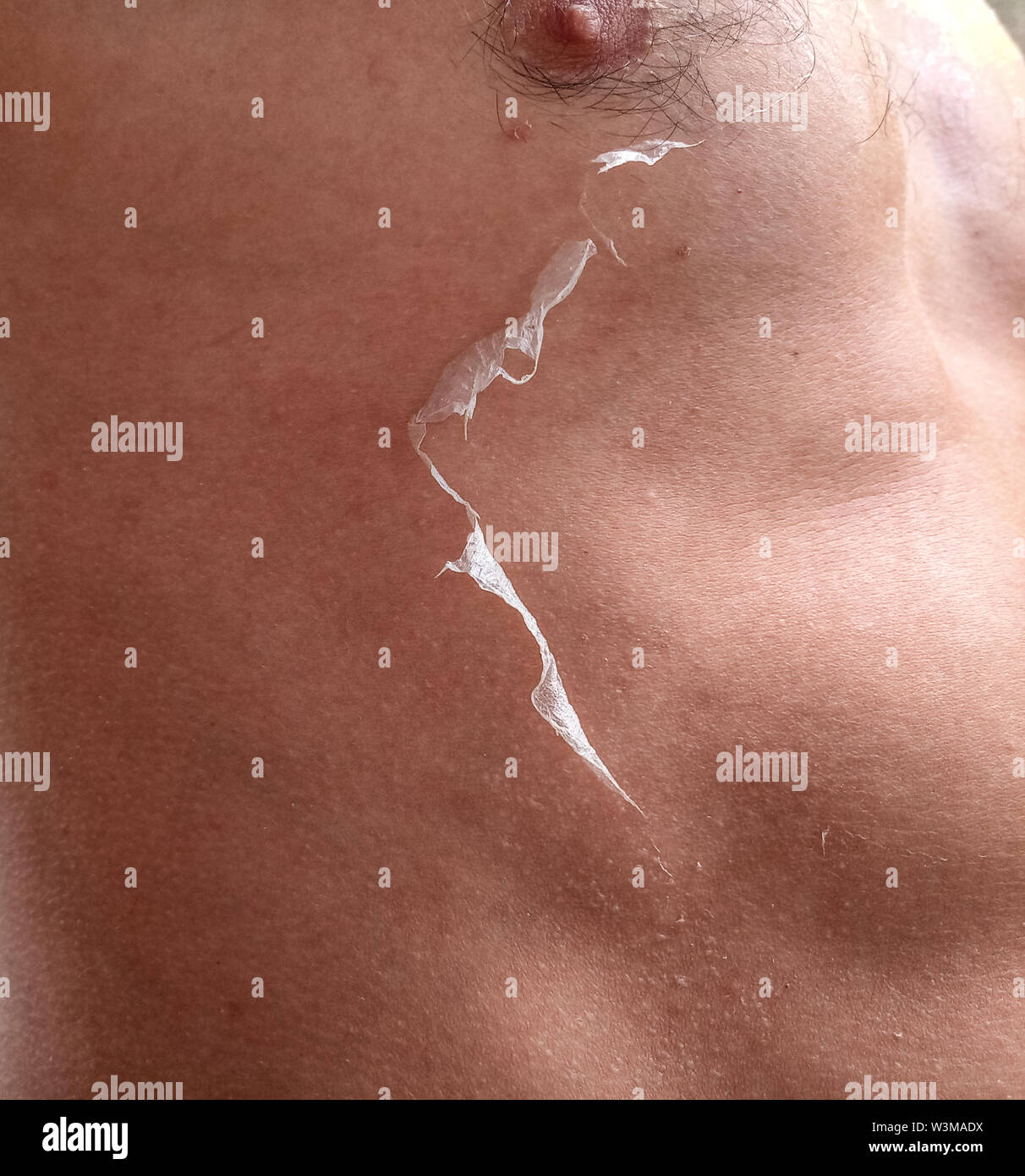 Les effets du coup de soleil sur la peau. Monter la peau. Banque D'Images Les effets du coup de soleil sur la peau. Monter la peau. Banque D'Images